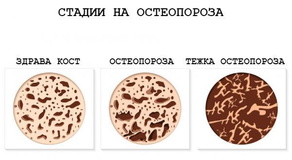 Остеопорозата:  За да я спрем, трябва да я познаваме!